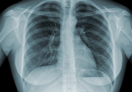 Raio-X de um tórax contaminado pela Tuberculose.